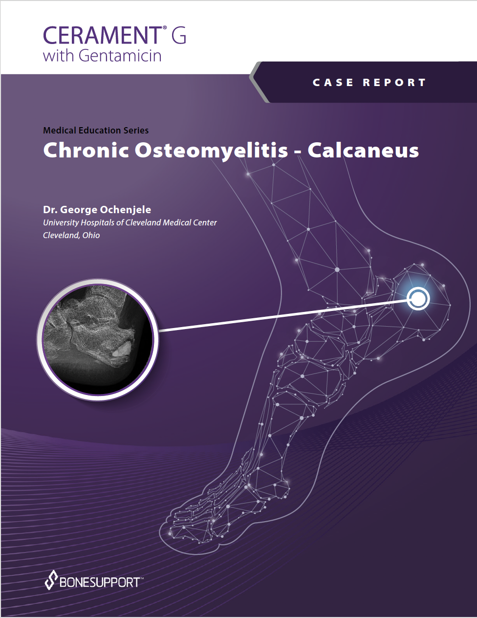 Chronic Osteomyelitis – Calcaneus